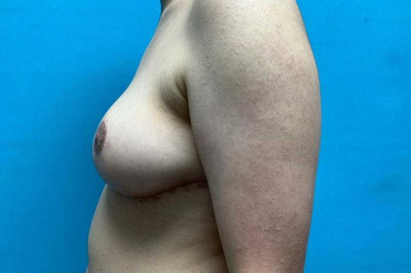 Breast Reduction Before & After Gallery - Patient 8795161 - Image 6
