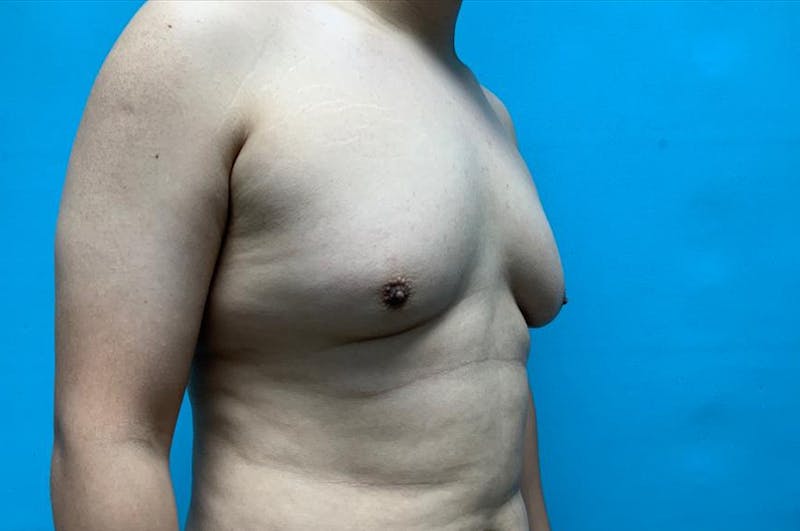 Gynecomastia Before & After Gallery - Patient 8795164 - Image 3