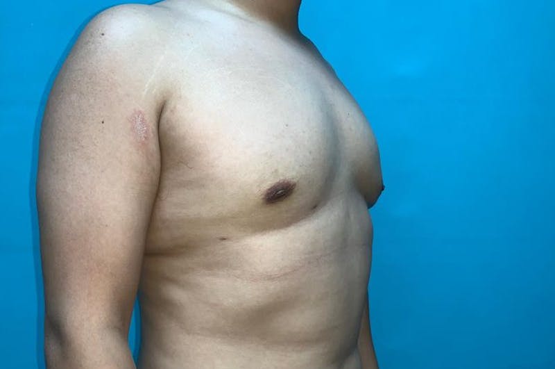 Gynecomastia Before & After Gallery - Patient 8795164 - Image 4