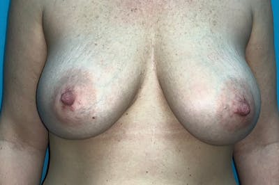 Mastopexy Before & After Gallery - Patient 8795166 - Image 1