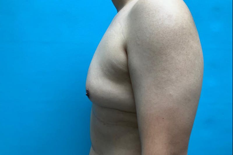 Gynecomastia Before & After Gallery - Patient 8795164 - Image 5