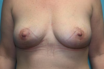 Mastopexy Before & After Gallery - Patient 8795166 - Image 2