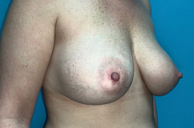 Mastopexy Before & After Gallery - Patient 8795166 - Image 3