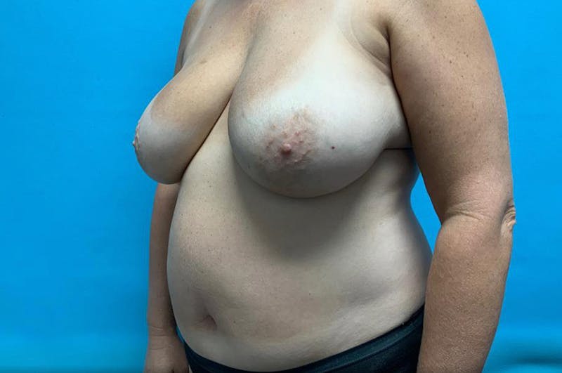 Breast Reduction Before & After Gallery - Patient 8795167 - Image 3