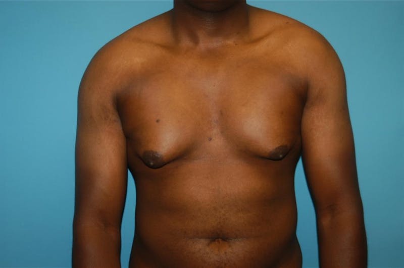 Gynecomastia Before & After Gallery - Patient 8795168 - Image 1
