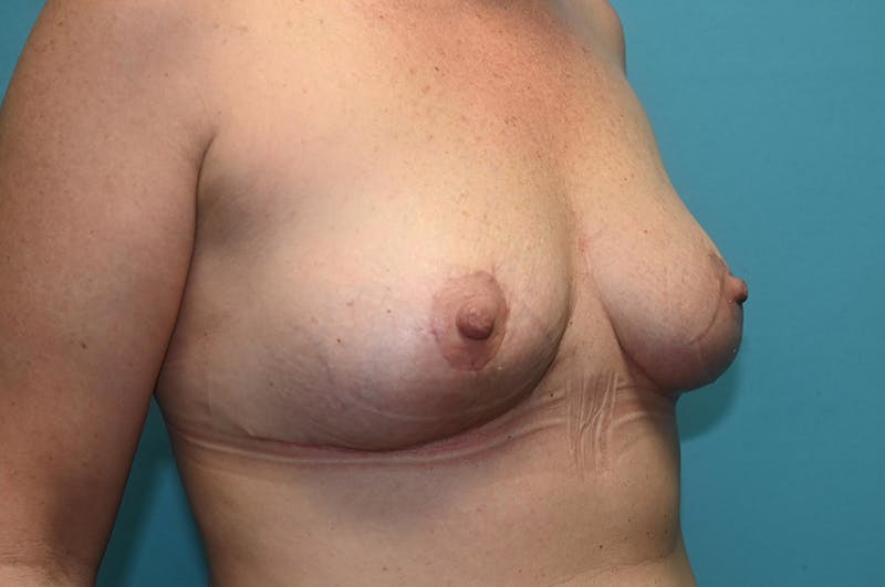 Mastopexy Before & After Gallery - Patient 8795166 - Image 4