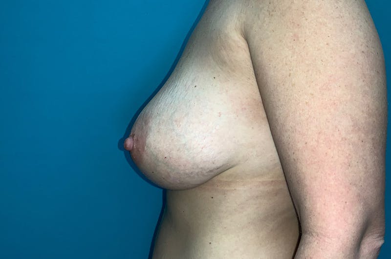 Mastopexy Before & After Gallery - Patient 8795166 - Image 5