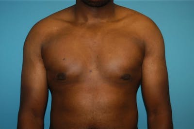 Gynecomastia Before & After Gallery - Patient 8795168 - Image 2