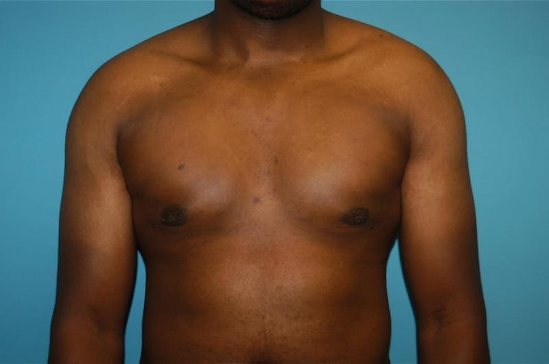 Gynecomastia Before & After Gallery - Patient 8795168 - Image 2