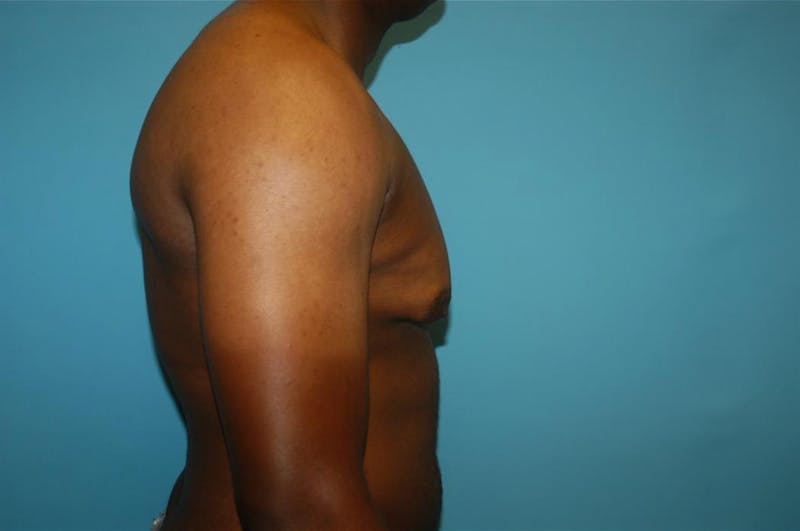 Gynecomastia Before & After Gallery - Patient 8795168 - Image 3