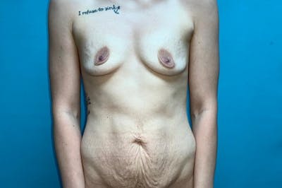 Mastopexy Before & After Gallery - Patient 8795187 - Image 1