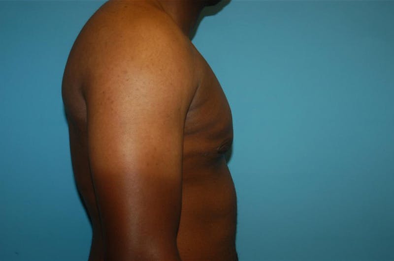Gynecomastia Before & After Gallery - Patient 8795168 - Image 4