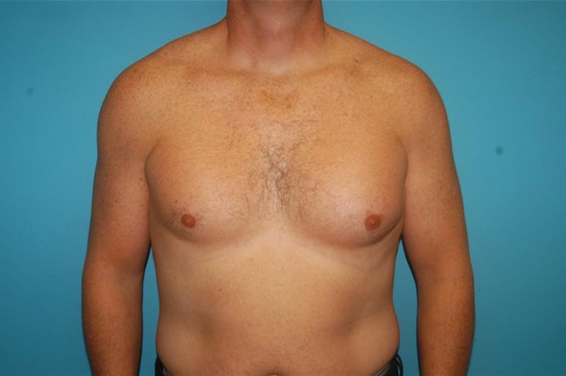 Gynecomastia Before & After Gallery - Patient 8795188 - Image 1