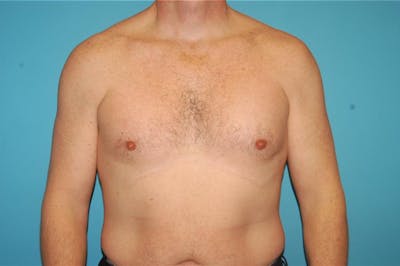 Gynecomastia Before & After Gallery - Patient 8795188 - Image 2