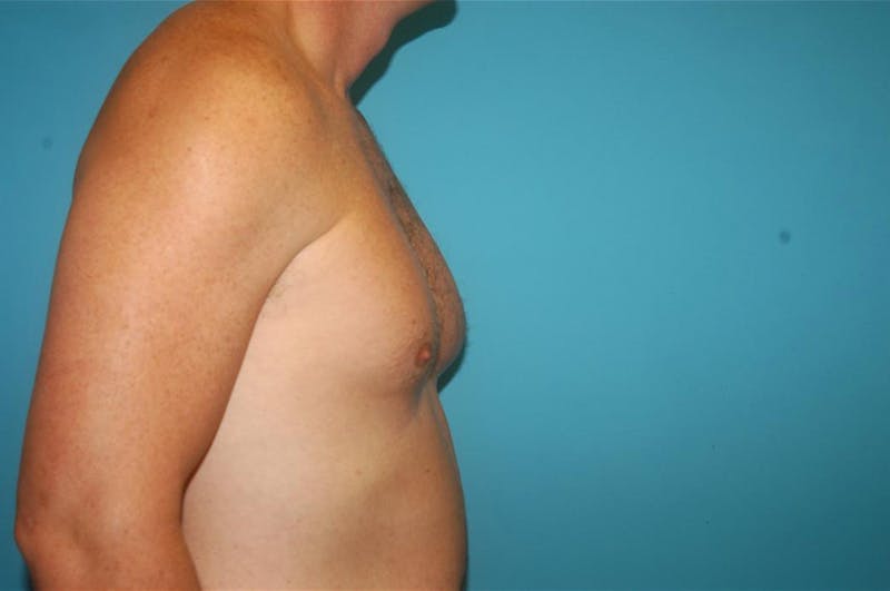 Gynecomastia Before & After Gallery - Patient 8795188 - Image 3
