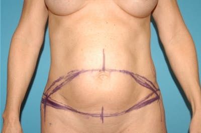 Abdominoplasty Before & After Gallery - Patient 8795186 - Image 1