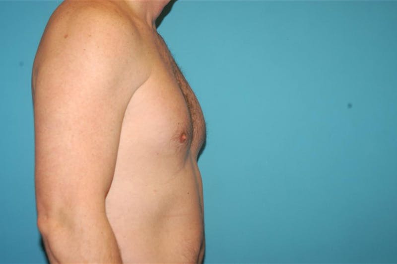 Gynecomastia Before & After Gallery - Patient 8795188 - Image 4