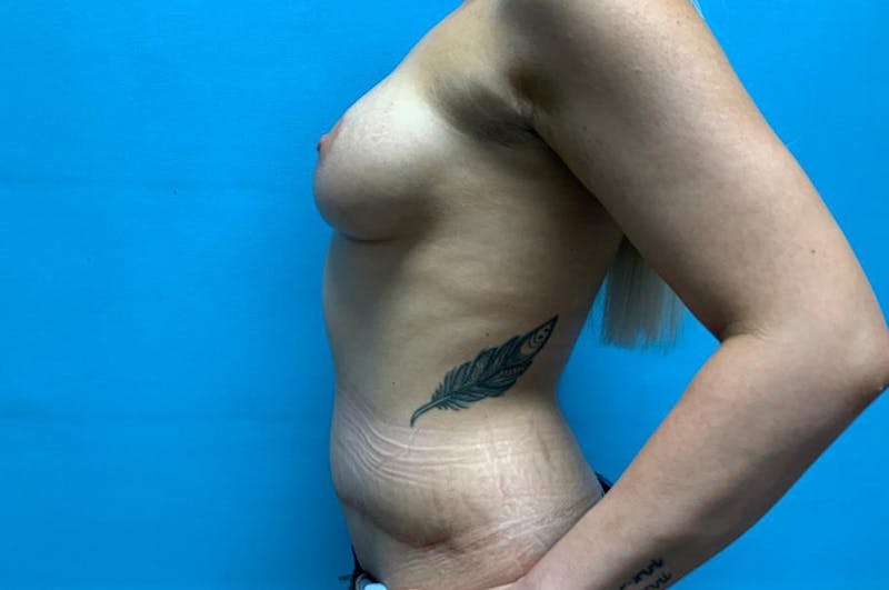 Mastopexy Before & After Gallery - Patient 8795187 - Image 6