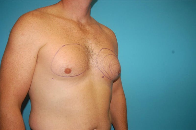 Gynecomastia Before & After Gallery - Patient 8795188 - Image 5