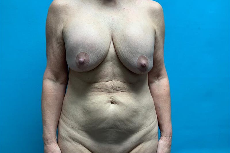 Mastopexy Before & After Gallery - Patient 8795192 - Image 1