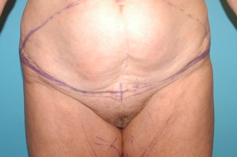Abdominoplasty Before & After Gallery - Patient 8795189 - Image 1