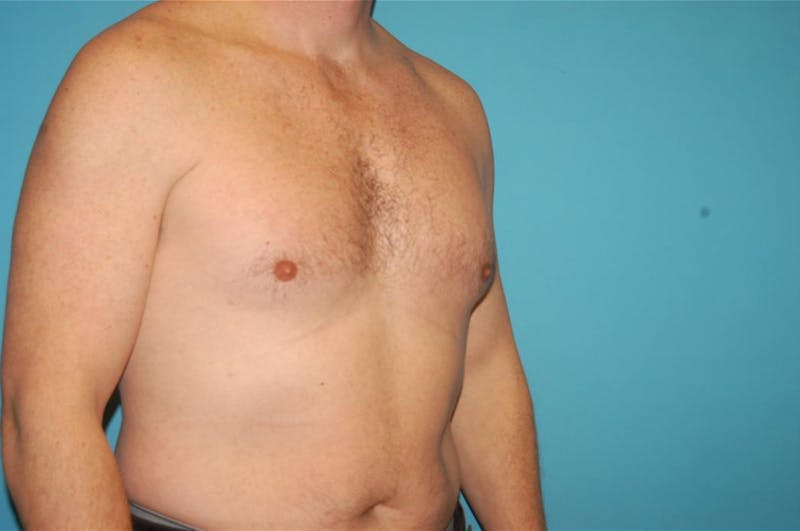 Gynecomastia Before & After Gallery - Patient 8795188 - Image 6