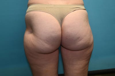 Fat Grafting Before & After Gallery - Patient 8795193 - Image 1