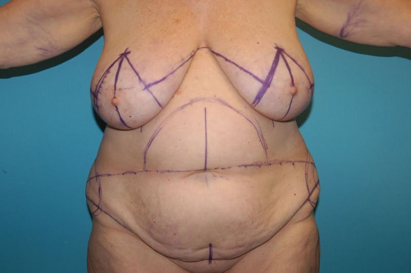 Abdominoplasty Before & After Gallery - Patient 8795190 - Image 1