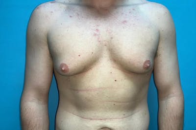 Gynecomastia Before & After Gallery - Patient 8795195 - Image 1