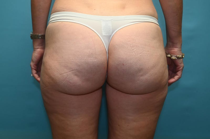 Fat Grafting Before & After Gallery - Patient 8795193 - Image 2