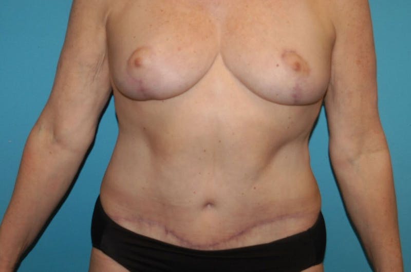 Abdominoplasty Before & After Gallery - Patient 8795190 - Image 2