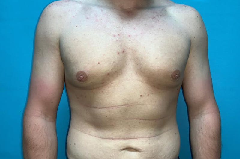 Gynecomastia Before & After Gallery - Patient 8795195 - Image 2