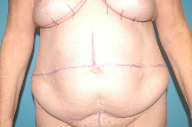 Abdominoplasty Before & After Gallery - Patient 8795191 - Image 1