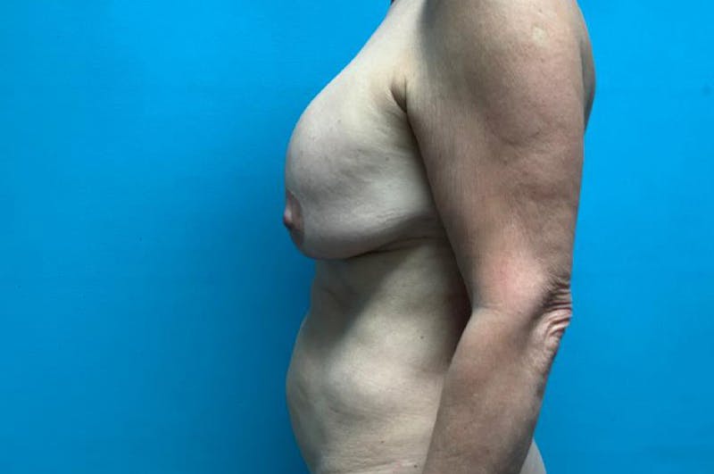 Mastopexy Before & After Gallery - Patient 8795192 - Image 5