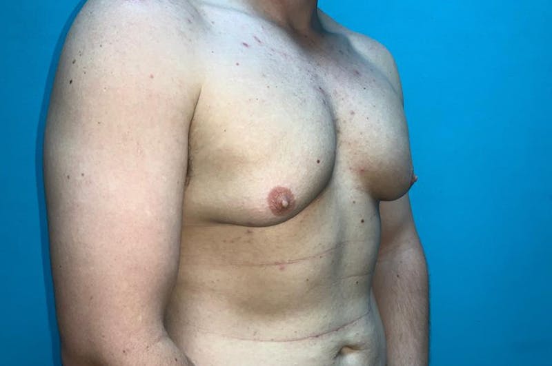 Gynecomastia Before & After Gallery - Patient 8795195 - Image 3