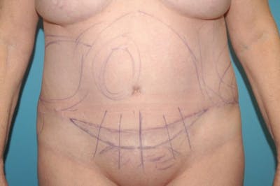 Abdominoplasty Before & After Gallery - Patient 8795191 - Image 2