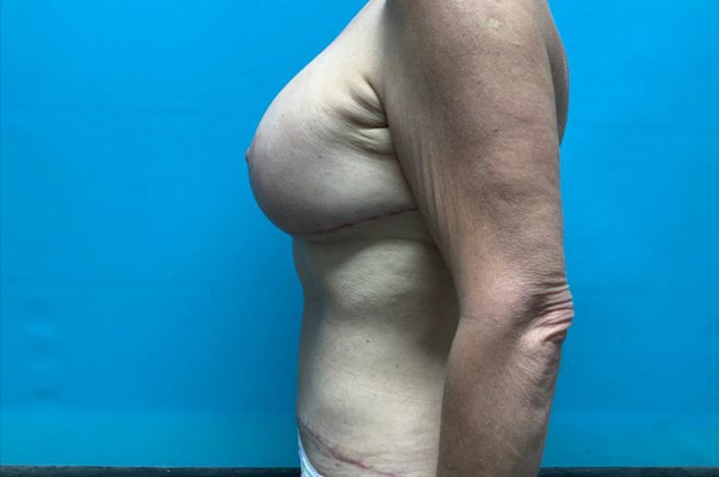 Mastopexy Before & After Gallery - Patient 8795192 - Image 6