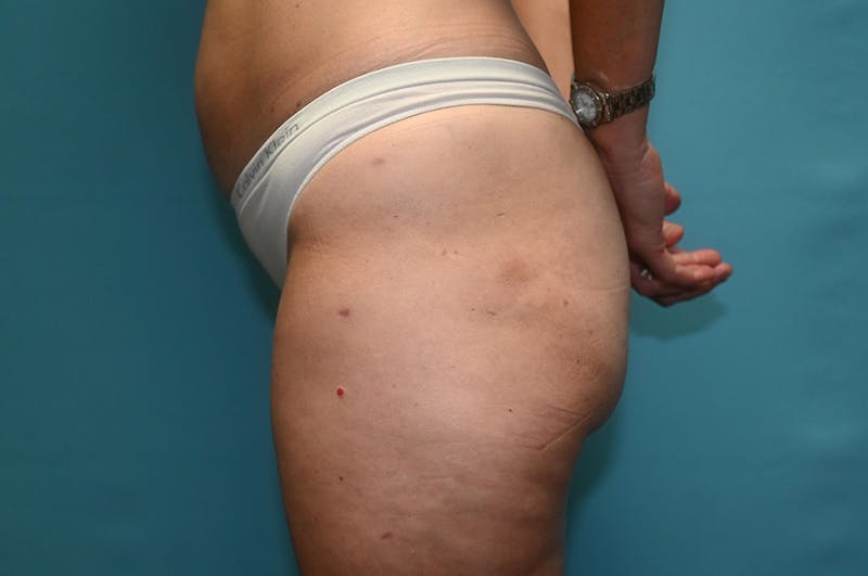 Fat Grafting Before & After Gallery - Patient 8795193 - Image 6