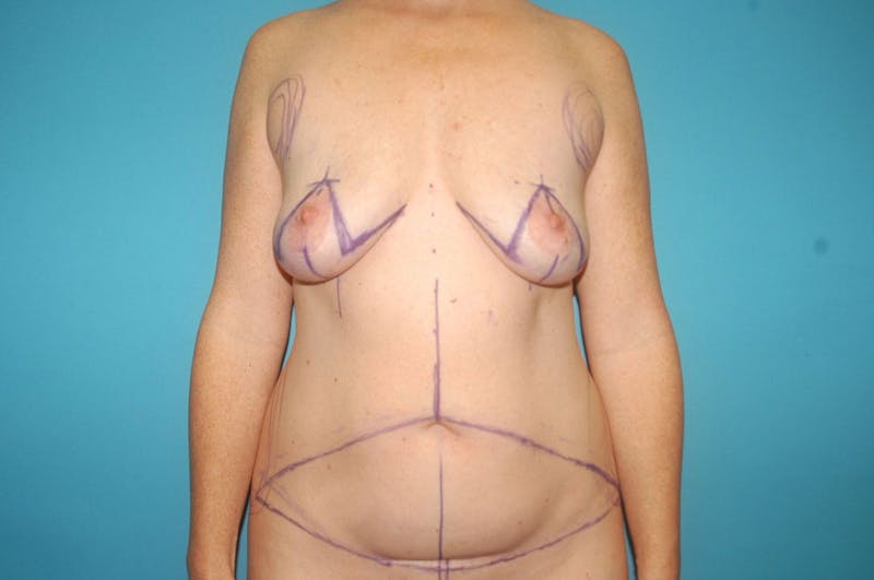 Abdominoplasty Before & After Gallery - Patient 8795194 - Image 1
