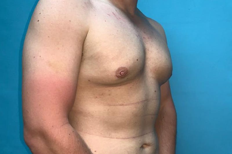Gynecomastia Before & After Gallery - Patient 8795195 - Image 4