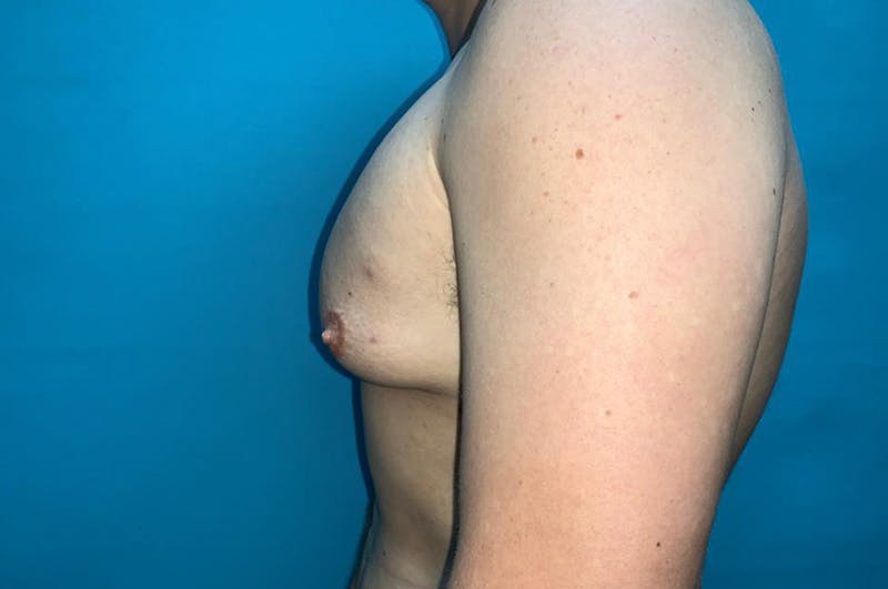 Gynecomastia Before & After Gallery - Patient 8795195 - Image 5