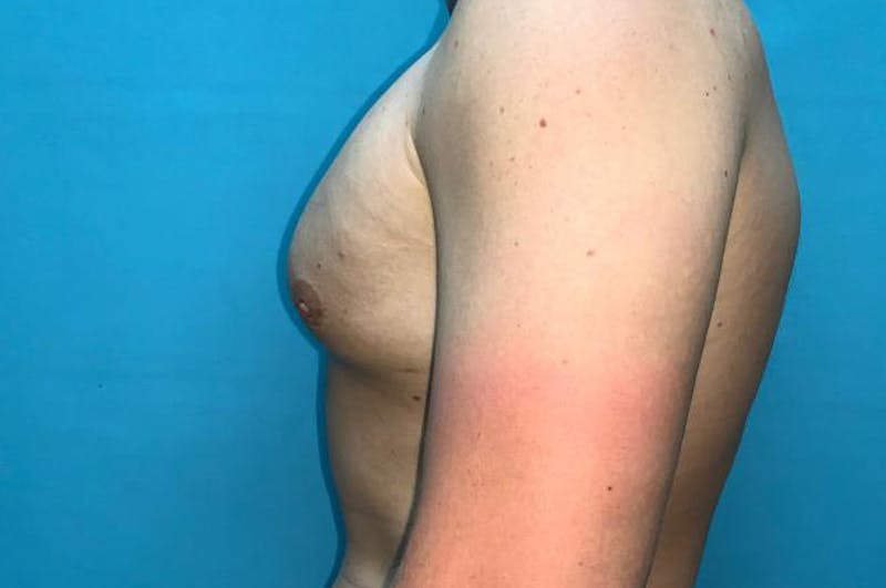 Gynecomastia Before & After Gallery - Patient 8795195 - Image 6