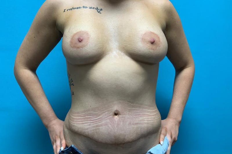 Abdominoplasty Before & After Gallery - Patient 8795220 - Image 2