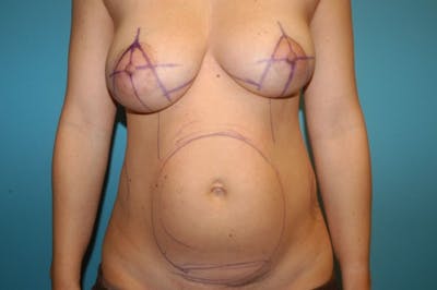 Liposuction Before & After Gallery - Patient 8795219 - Image 1