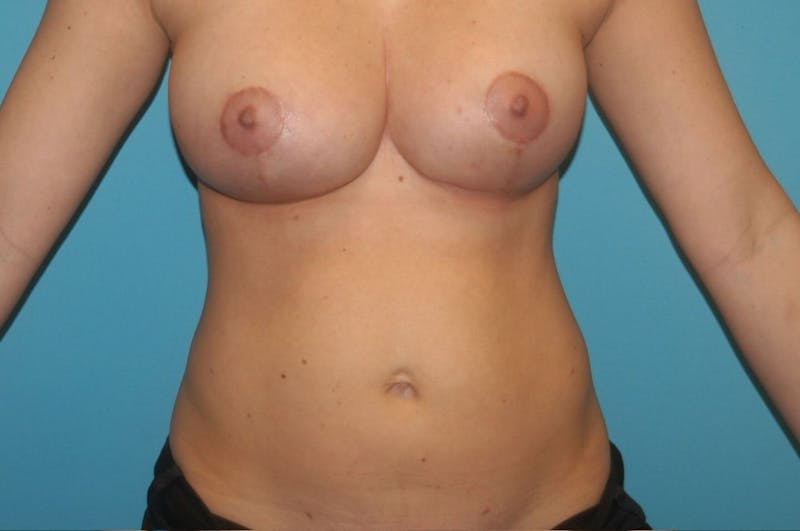 Liposuction Before & After Gallery - Patient 8795219 - Image 2