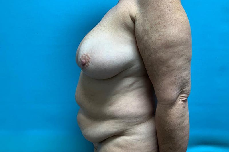 Mastopexy Before & After Gallery - Patient 8795222 - Image 5