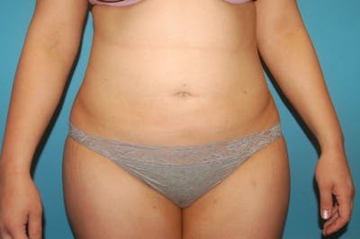 Liposuction Before & After Gallery - Patient 8795221 - Image 2