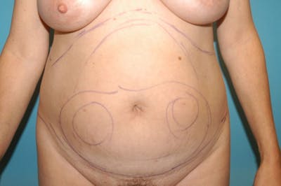 Liposuction Before & After Gallery - Patient 8795223 - Image 1