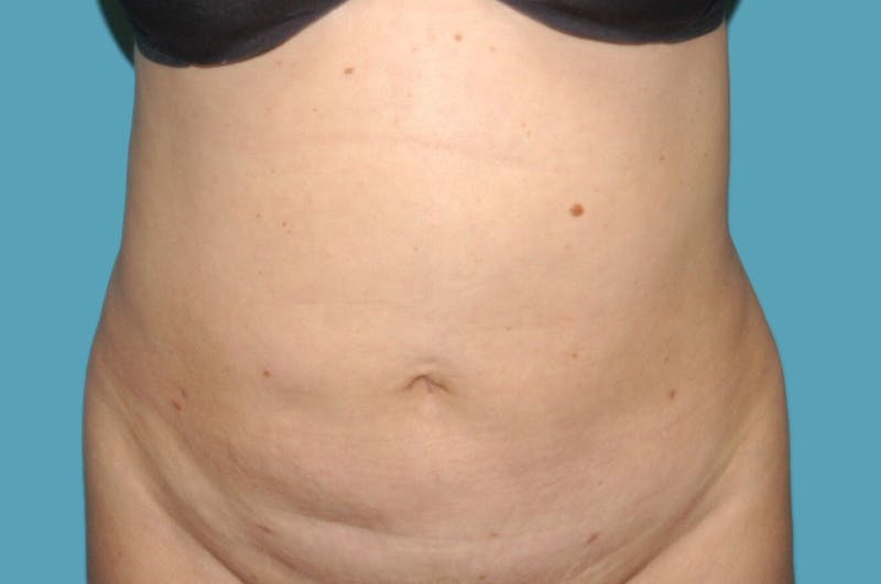 Liposuction Before & After Gallery - Patient 8795223 - Image 2
