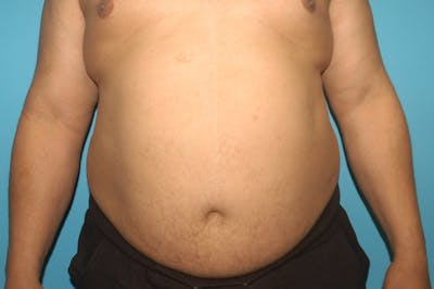 Liposuction Before & After Gallery - Patient 8795248 - Image 1